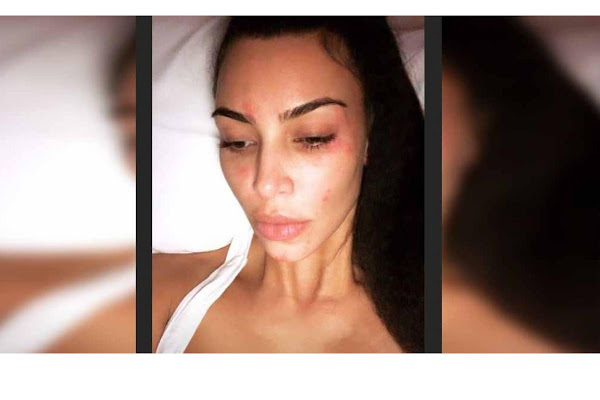Kim publicó en Instagram la evolución de la enfermedad. Foto: Agencias