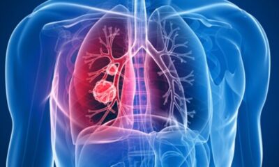 Casos de cáncer de pulmón