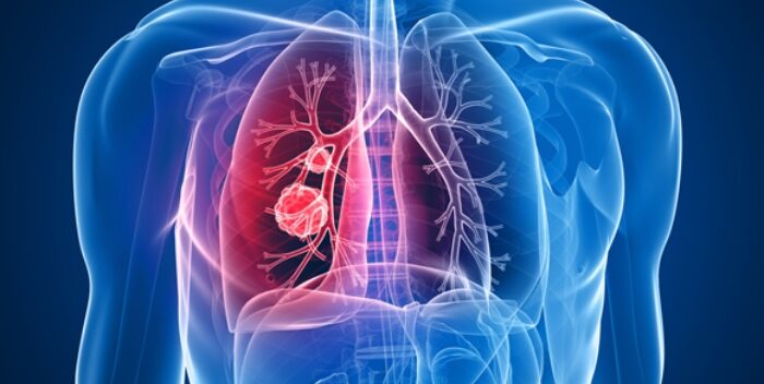 Casos de cáncer de pulmón