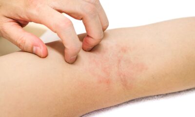 dermatitis atópica en Venezuela