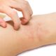 dermatitis atópica en Venezuela