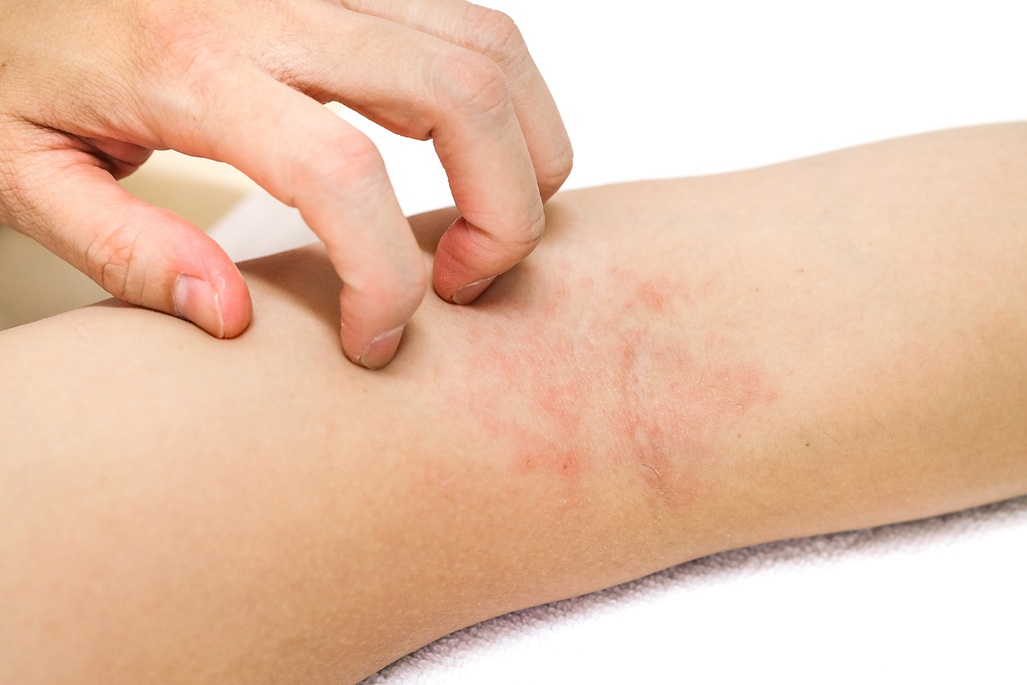dermatitis atópica en Venezuela