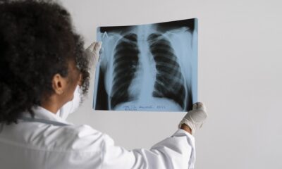 Cáncer de pulmón Venezuela
