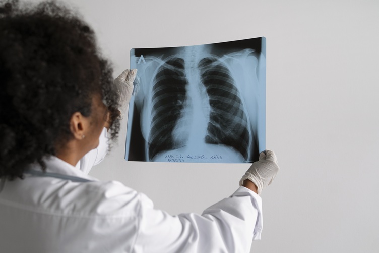 Cáncer de pulmón Venezuela
